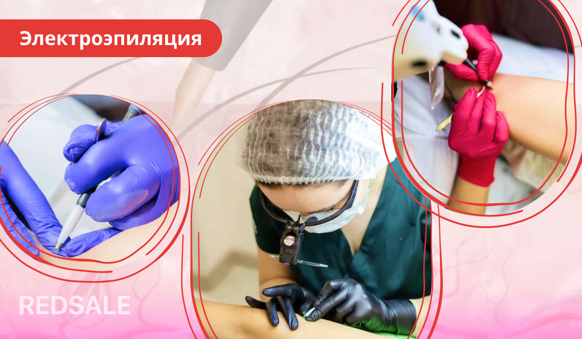 Процедура электроэпиляции: специалист в медицинской одежде и перчатках удаляет волосы с кожи клиента с помощью специального прибора.