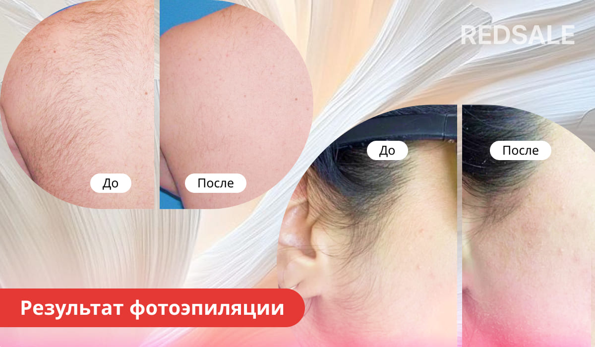 Сравнение кожи до и после процедуры фотоэпиляции: слева участки кожи с заметными волосами, справа – гладкая кожа без волос.