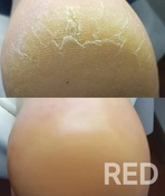 Обработка пяток от трещин. Они бывают глубокими и поверхностными. Сухие, от дефицита влаги и влажные, от постоянного мокнутия кожи. Делятся по группам:
а) результат эндогенного сбоя;
б) результат внешних факторов (неуд-я обувь). Проводится диагностика.