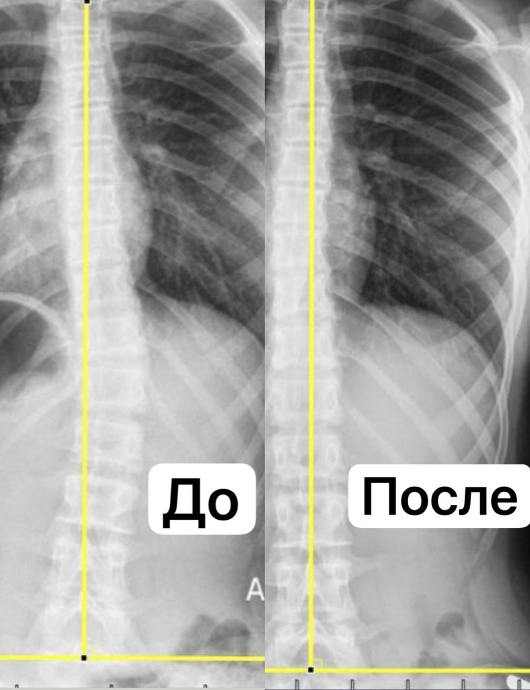 Промежуточный результат коррекции сколиоза.