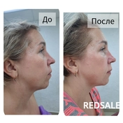 Результат после 1-го сеанса хиромассажа лица.