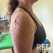 Тейпирование паретичного плеча пациента после инсульта.
