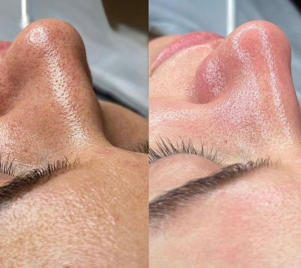 Комбинированная чистка лица самый эффективный способ для чистки вашей кожи.