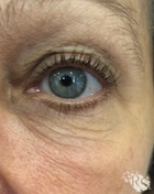 Ботокс ресниц, фирма «My Lashes»
