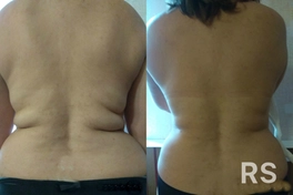 Результаты на лицо. Было 12 сеансов по 1,5 часа, 9 обертываний по 45 мин.