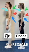 На данных фотографиях вы можете заметить положительную динамику - уменьшение грудного выпячивания со стороны спины, улучшение осанки (разворот плеч назад).