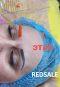 Первый этап перекрытие старого  синего татуажа, 