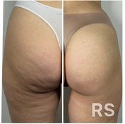 Состояние кожи после пяти процедур антицеллюлитного аппаратного массажа и стоун-терапии.