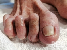 Медицинский (подологический) педикюр --это аппаратная процедура безопасного лечения и обработки стоп, направленная на оздоровление, устранение вросших ногтей, стержневых мозолей, трещин и грибковых поражений. Выполняется с использованием стерильных инст-ов.