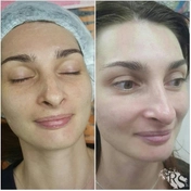 Механическая чистка лица с фруктовыми кислотами 