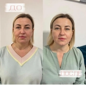 Омоложение лица