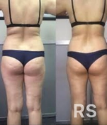 Состояние ягодиц и бёдер после всего комплекса процедур через 5-7 регулярных сеансов.