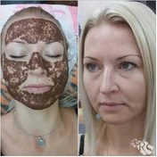 Уходовая процедура лица по типу кожи с маской из растительного коллагена 