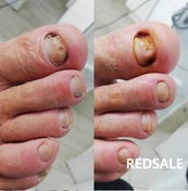 Обработка ногтей поражённые онихомикозом, зачистка. Фото до и после процедуры. 