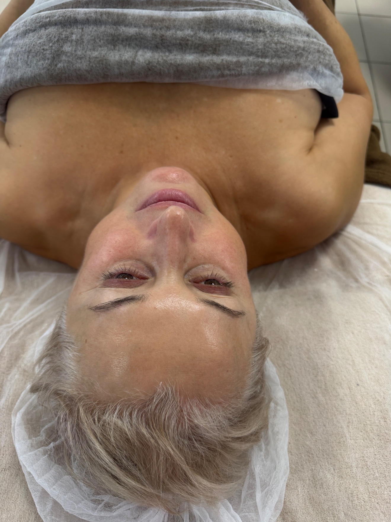 Микронидлинг с коктейлем для выравнивания структуры кожи и цвета лица.